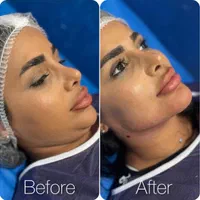 سوپرساکشن غبغب همراه بازاویه سازی تخصصی گردنُ صورت|خدمات آرایشگری و زیبایی|تهران, پاسداران|دیوار