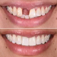 پر کردن دندان با تخفیف ویژه