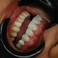 تخفیف ویژه ویژه ویژه روکش|خدمات آرایشگری و زیبایی|تهران, جوادیه|دیوار