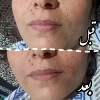 اف ۵۰٪ژل و بوتاکس و مزو...|خدمات آرایشگری و زیبایی|اهواز, اهواز|دیوار