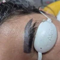 لیزر پاک تاتو ماه گرفتگی کک مک ترک بارداری لاغری