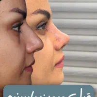 عمل جراحی بینی فقط ۲۴ میلیون/لیفت صورت/کرج و تهران|خدمات آرایشگری و زیبایی|قزوین, |دیوار