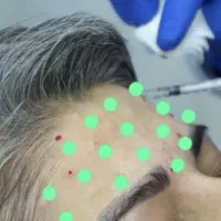 دیمونو مزو ژل ها میکرونیلدینگ