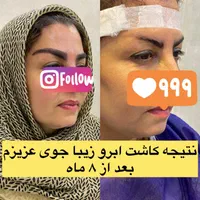 کاشت ابرو  دائمی تخصصی وپرتراکم و با خواب مناسب