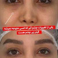تزریق لب روسی/فیلر بادی/بوتاکس/مزوژل/prp|خدمات آرایشگری و زیبایی|تهران, تهرانپارس غربی|دیوار