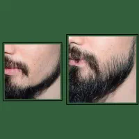 رویش ریش و سیبیل