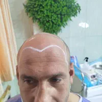 کاشت مو،ریش ،سیبیل،ابرو،پی آرپی ومزوتراپی|خدمات آرایشگری و زیبایی|بوشهر, |دیوار