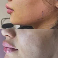 تخفیفات ژل وبوتاکس برای خانمهاواقایون|خدمات آرایشگری و زیبایی|قرچک, مهدیه|دیوار