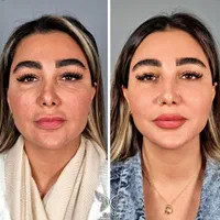مدل جوانسازی و زیباسازی ولیفت صورت رفع چروک ولک