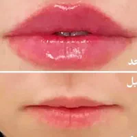 تزریق ژل و بوتاکس و فیلر بادی باتخفیف توسط پزشک|خدمات آرایشگری و زیبایی|شیراز, کلاهدوز|دیوار