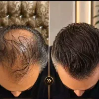 دیگر نیازی به کاشت مو نیست