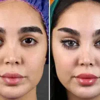 تزریق ژل وبوتاکس ۷۹۰. مید فیس ۴۵۰۰توسط پزشک مجرب