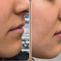 زیبایی طبیعی صورت با فیلر