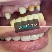 دندانسازی ناب نصف قیمت بازار