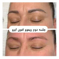 هایفو جوانساز، کیوسوئیچ، ریموو تتو،لیزر موهای زائد|خدمات آرایشگری و زیبایی|آبادان, |دیوار