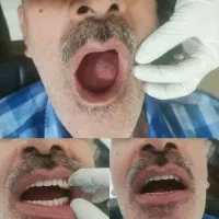 تخفیفات وشرایط اقساطی برای ایمپلنت و پروتز مصنوعی|خدمات آرایشگری و زیبایی|بجنورد, |دیوار