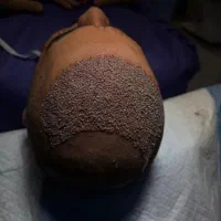 جشنواره کاشت مو