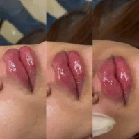 جشنواره آموزش خصوصی تزریق ژل و بوتاکس