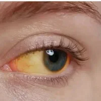 تا حالا فکر کردی علت زردی چشمت برای چیه