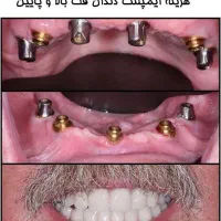 کاشت دندان بدون پیش پرداخت و اقساط بلند مدت