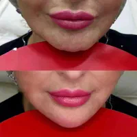 جذب مدل ژل صورت مخصوص فرمدهی و جوانسازی|خدمات آرایشگری و زیبایی|اندیمشک, |دیوار