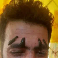 زالودرمانی،حجامت و بادکش، دیسک و سیاتیک،