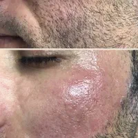 لیزر آقایان و بانوان|خدمات آرایشگری و زیبایی|تبریز, |دیوار