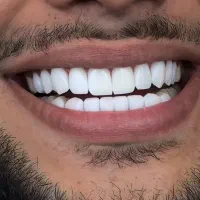 جشنواره کامپوزیت دندان|خدمات آرایشگری و زیبایی|کرج, کوی کارمندان شمالی|دیوار