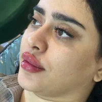 فیلر لب قیمت ویژه وهایفوتخفیف فوق العاده|خدمات آرایشگری و زیبایی|یزد, |دیوار