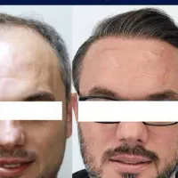 کاشت مو و ابرو طبیعی|خدمات آرایشگری و زیبایی|اصفهان, شاهزید|دیوار