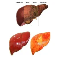 کبدچرب داری درمان نکردی ها