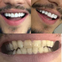 کامپوزیت و لمینت دندان|خدمات آرایشگری و زیبایی|ساری, |دیوار