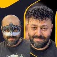 پروتز مو جایگزینی مناسب کاشت مو .تولید در همدان.