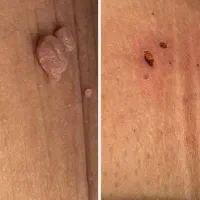 محلول پاک کننده انواع زگیل و زگیل تناسلی