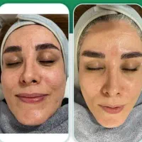 لیزر (750.950)اقایون و خانوما.فشیال و خالبرداری