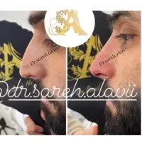 اصلاح فرم بینی بدون جراحی و بیهوشی توسط پزشک|خدمات آرایشگری و زیبایی|قم, دورشهر|دیوار