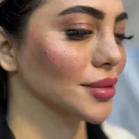 با یک فول فیس ۹میلیونی بوتاکس رایگان هدیه بگیرید
