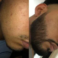 راهکار کم‌پشتی ریش
