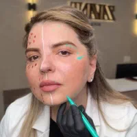 تخفیف بینظیر بوتاکس مصپورت پیشانی