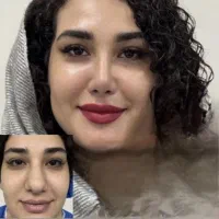 بینی زیبا با دکتر اسدالله پور فقط با۳۱م