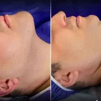 رفع غبغب فیلربادی لیفت بینی صورت بلفارو شقیقه چربی