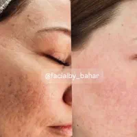 مزونیدلینگ حرفه‌ای در کلینیک زیبایی/هاشمیه|خدمات آرایشگری و زیبایی|مشهد, چهارچشمه|دیوار