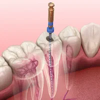 عصب‌کشی دندان در کلینیک پردیس انزلی با حداقل هزینه