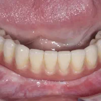 ایمپلنت،اوردنچر دو فک ۱۰۰ تومن در تبریز|خدمات آرایشگری و زیبایی|اهر, |دیوار