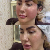 تزریق چربی وفیلر لابیاپلاستی وغبغب ژل لب هیپ دیپ|خدمات زیبایی و سلامت|تهران, شکوفه (عبدل آباد)|دیوار