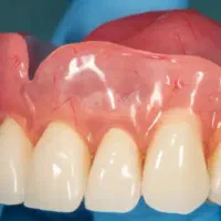 نصب دندان مصنوعی با شرایط شما