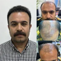 کاشت مو vip زیر نظر پزشک متخصص اقساط ویژه