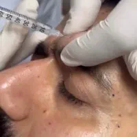 مصپورت فول فیس بوتاکس ۱/۵۵۰/۰۰۰