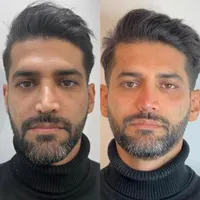 آموزش فیلر/بوتاکس/مزوتراپی|خدمات آموزشی|خرم‌آباد, |دیوار