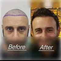 جشنواره کاشت موvipباضمانت فول تراکم ده تومن
